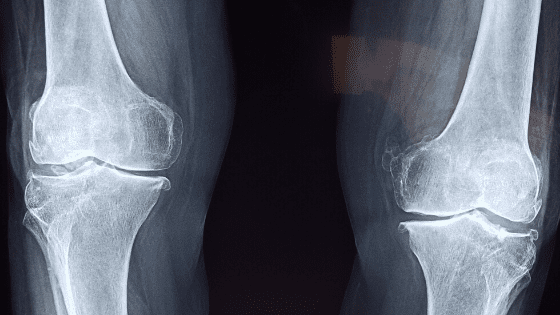 Arthritis