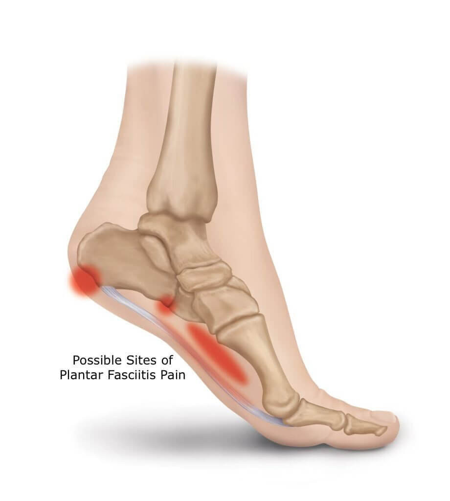 plantar fasciits