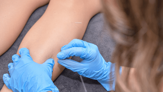 myotherapy dry needling